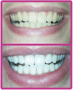 mobile-teeth-whitening